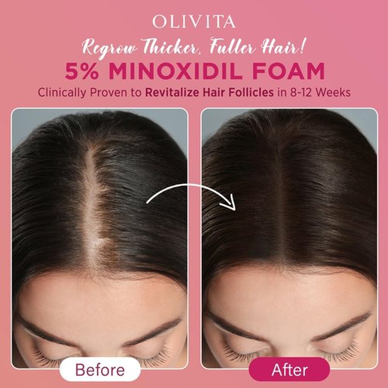 5% Minoxidil Foam for Women Hair Growth: Extra Strength Hair Regrowth Treatment – Revitalize Hair Follicles & Regrow Thicker, Fuller Hair – Hair Loss Solution-2 pack