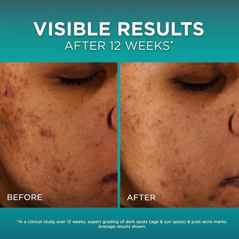 L’Oréal Paris Bright Reveal Dark Spot Serum - 12% Niacinamide & Amino Sulfonic - 1oz + Free Moisturizer Sample