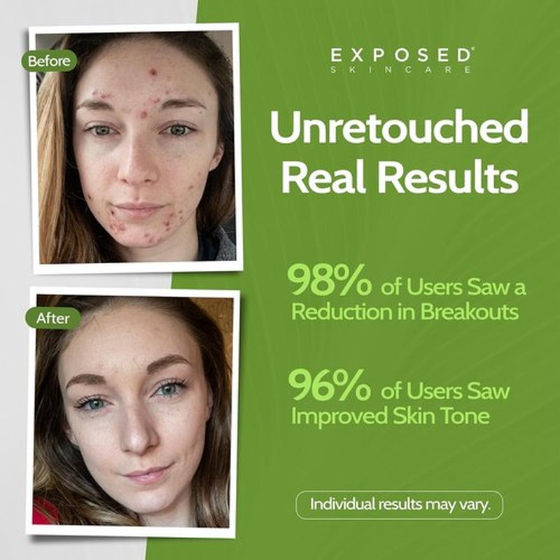 Exposed Skin Care Acne Treatment Kit - Clear Teen & Adult Acne with 2.5% Salicylic Acid & 3.5% Benzoyl Peroxide | Natural & Cruelty-Free