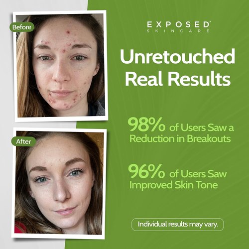 Exposed Skin Care Acne Treatment Mask - 3% Sulfur & Activated Charcoal for Oil Control | Natural & Cruelty-Free