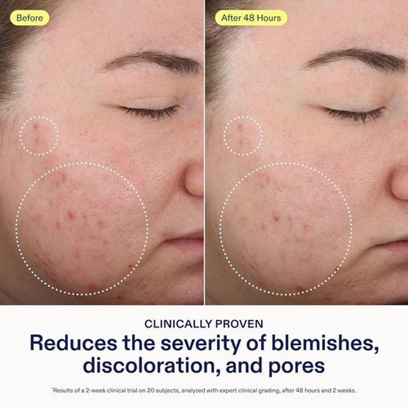 Skinfix 2% BHA Cleanser - Clears Acne Blemishes & Blackheads - 1 oz - Fragrance-Free, Vegan, Cruelty-Free