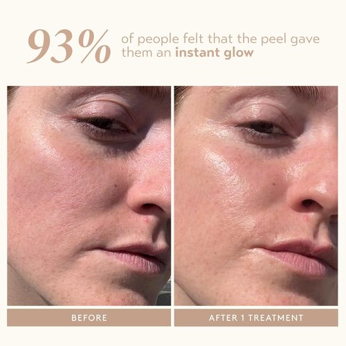 SHANI DARDEN SKIN CARE Triple Acid Peel - 2-Step Exfoliating Treatment with Mandelic, Lactic & Glycolic Acids | Includes Kaolin Clay Mask & Brush (0.5 fl oz)