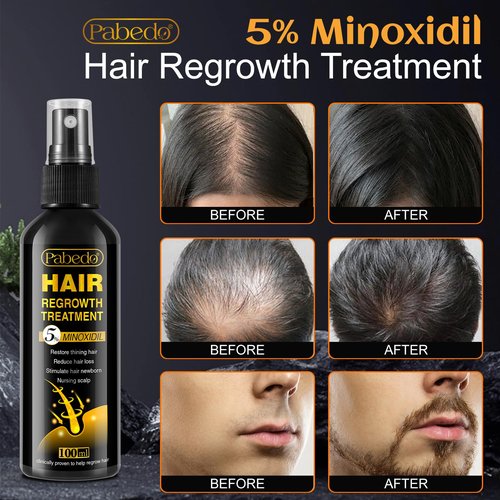 5% Minoxidil Hair Growth, Minoxidil Spray For Beard Growth Serum, Hair Growth oil Spray, Treating Hair Loss For Thicker Longer Fuller Healthier Hair, 3.38 Oz