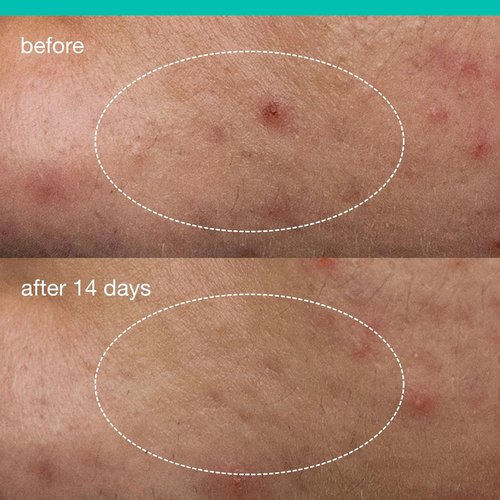 Dermalogica Deep Acne Liquid Patch - Sulfur Treatment with Niacinamide for Blemish-Prone Skin | 0.5 fl oz