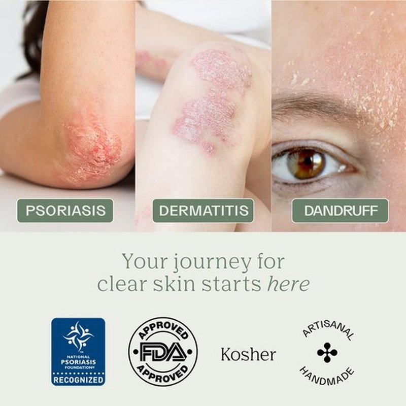 Dermabon Psoriasis, Dermatitis & Dandruff Control soap bar with 2% Coal Tar as its Active Ingredient - 1 Pack