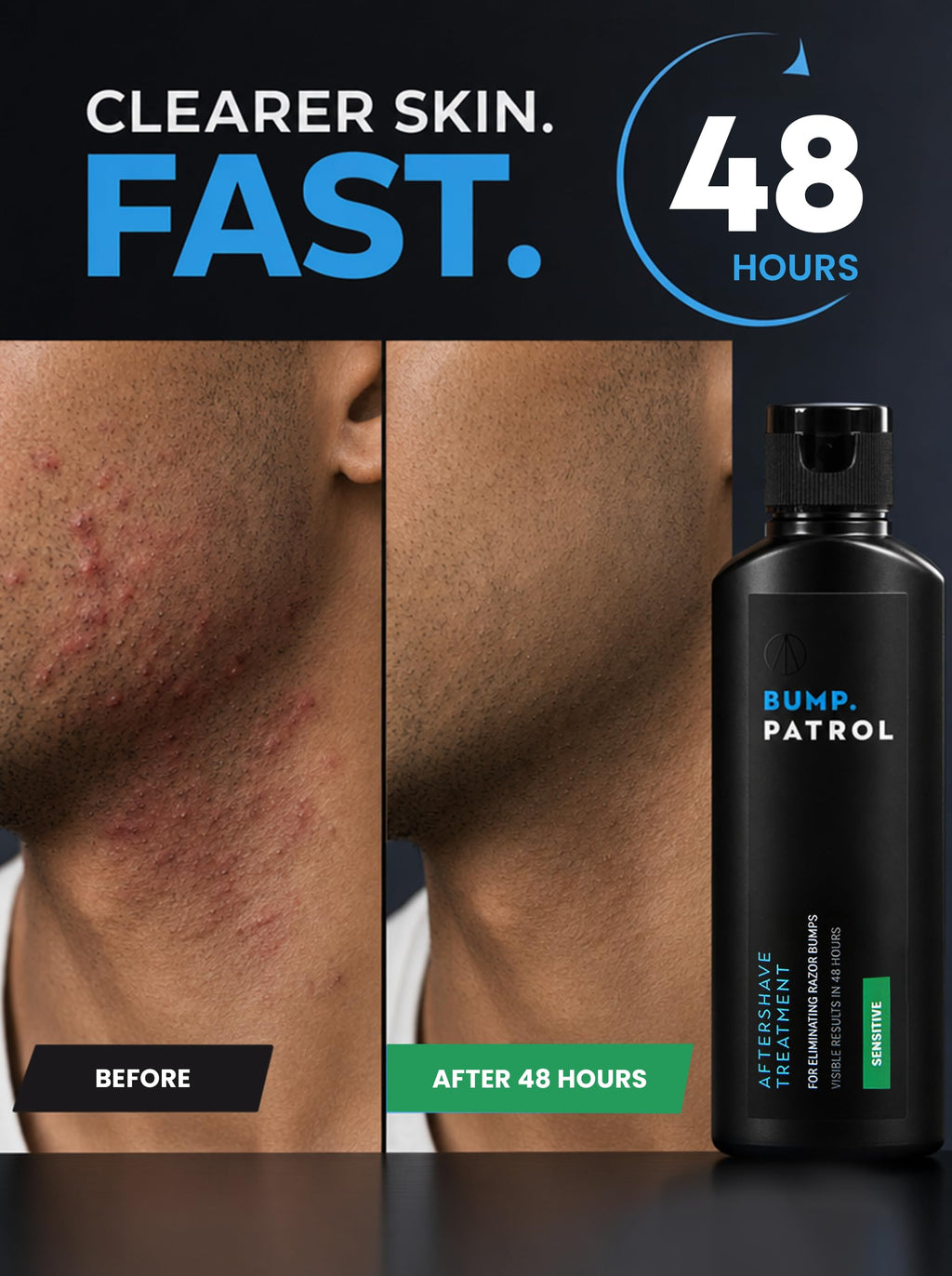 Bump Patrol Sensitive Strength Aftershave Treatment Serum – Razor Bump Stopper and Ingrown Hair Treatment for Men and Women, Alcohol Free Ingrown Hair Serum for Sensitive Skin