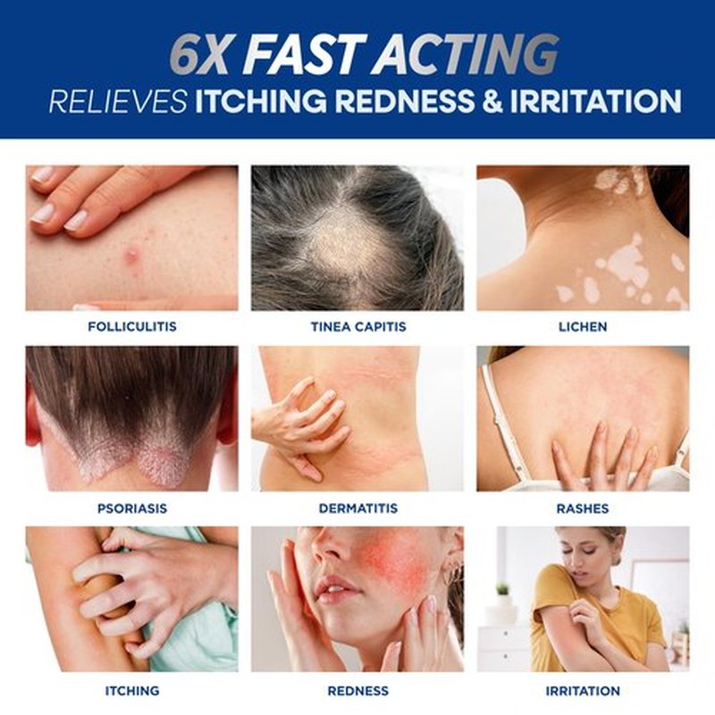 Hermon Folliculitis Cream: Effective for Folliculitis Scalp Face and Body 100g