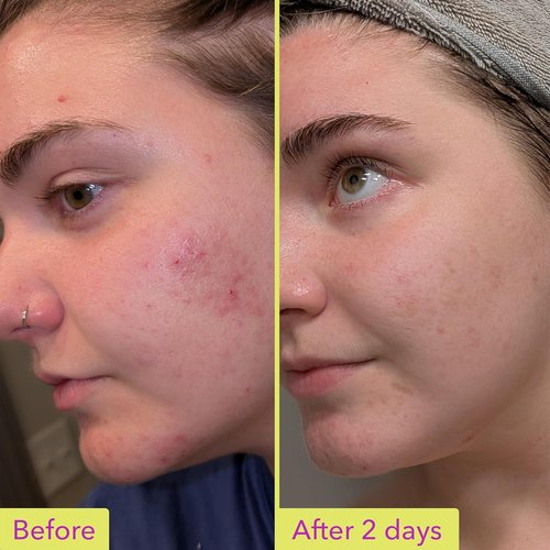 Good Molecules 10% Azelaic Acid Treatment - Soothing Formula for Redness & Uneven Tone | Brightens Dark Spots & Refines Texture | Vegan & Fragrance-Free (30ml)