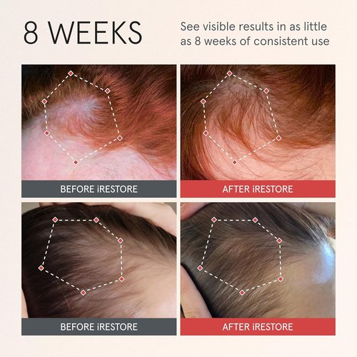 iRESTORE Scalp Serum - Hair Growth Solution for Men & Women | Redensyl, Capixyl & Biotin | 2 Fl Oz