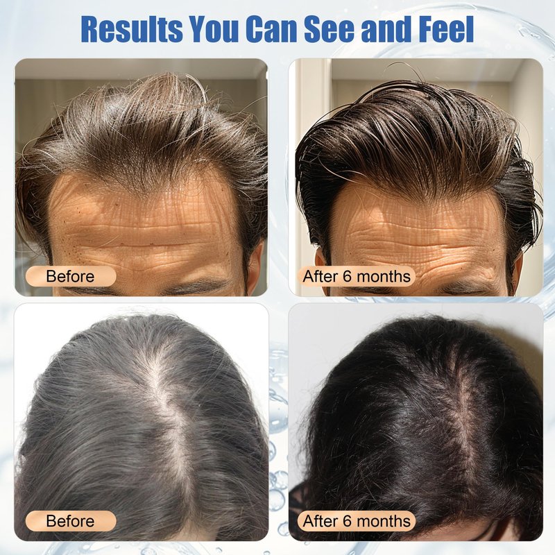 Yuaben Minoxidil Foam for Men and Women: 5% Infused with Biotin, Extra Strength, Regrowth Treatments to Combat Hair Loss, Dark Blue