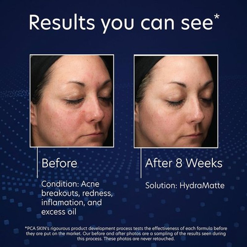 PCA SKIN HydraMatte Oil Control Moisturizer - Quick Absorbing Formula for Oily Skin | 1.8 oz Jar