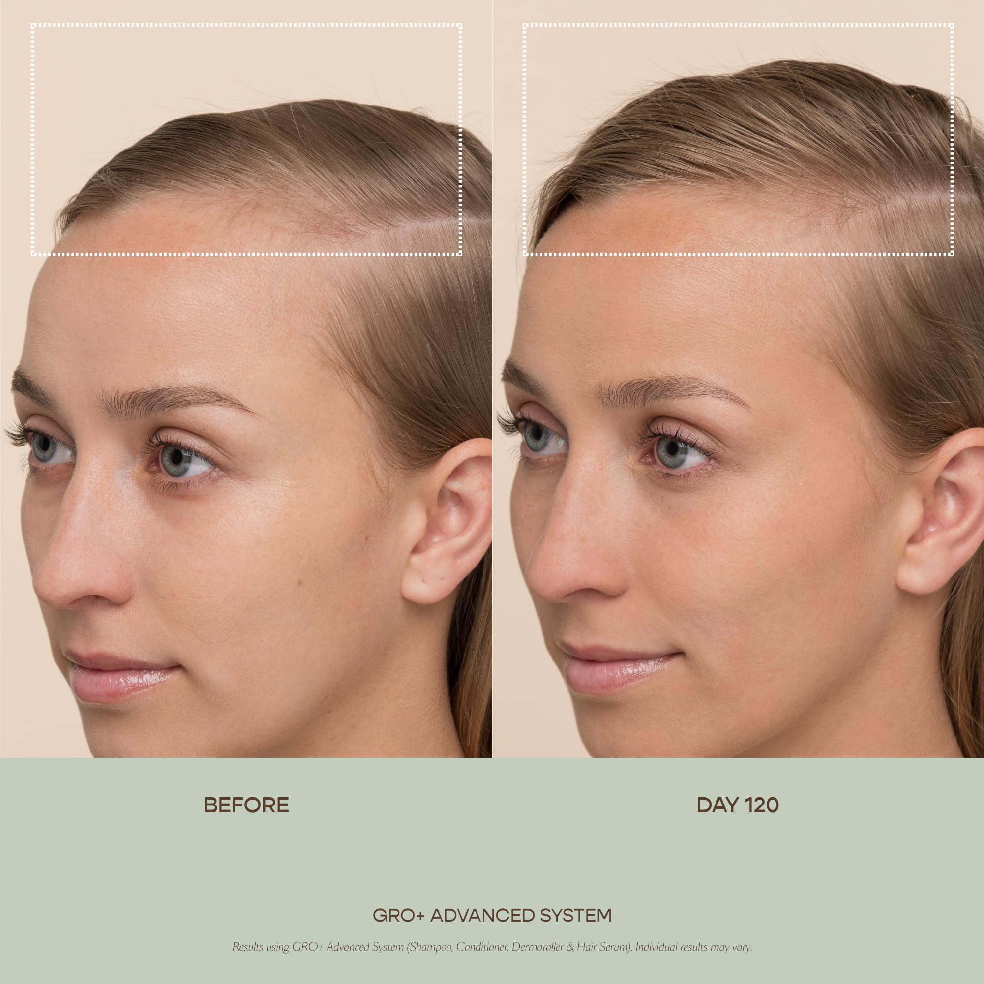 VEGAMOUR GRO+ Advanced Hair Serum for Improving Hair Density, Tonic Reduces Shedding and Promotes a Healthy Scalp, 1 pack