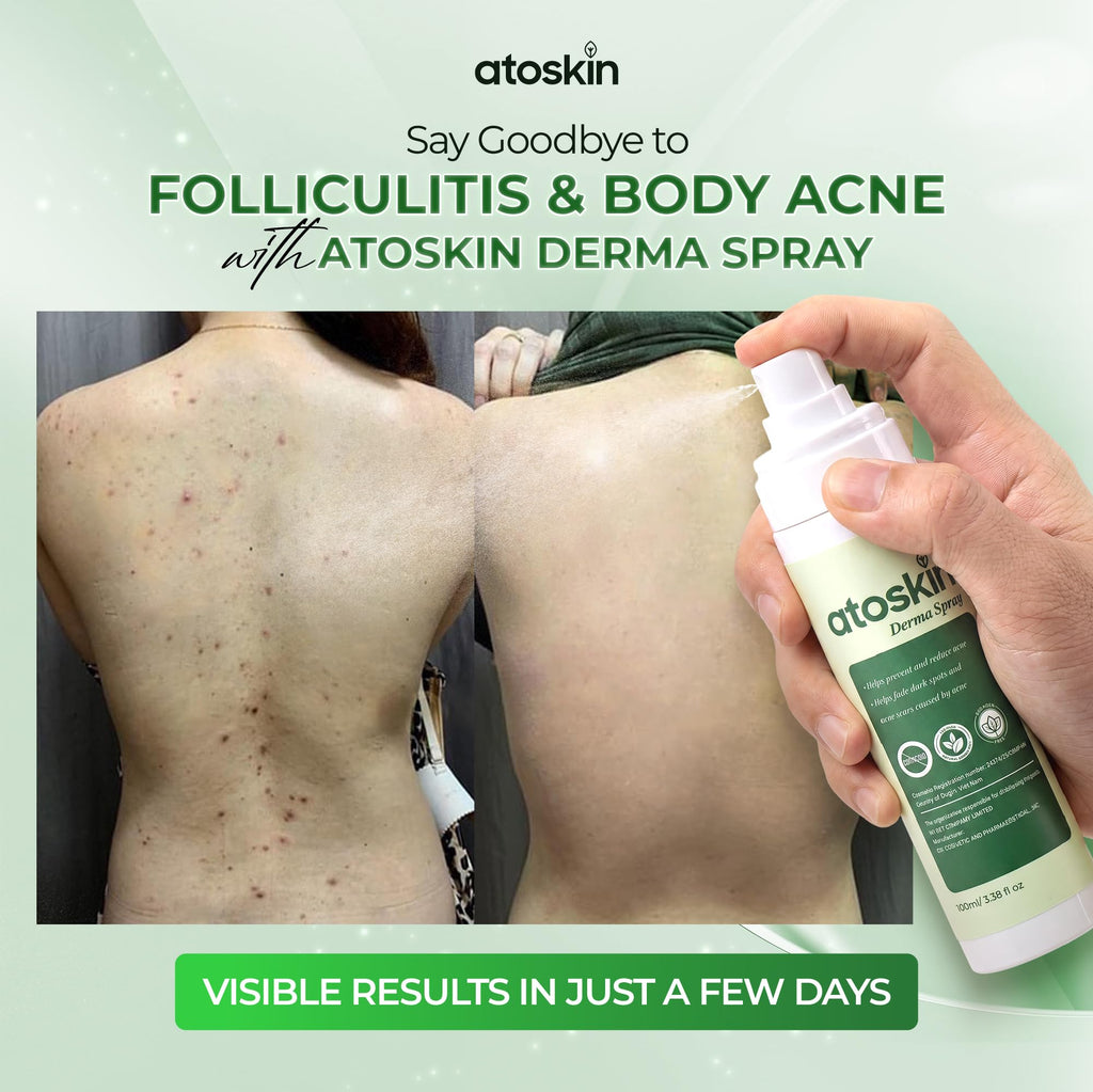 Atoskin Advanced Folliculitis & Back Acne Treatment Spray with 1.5% Glycolic Acid & 1% Zinc PCA - Reduces Redness & Keratosis Pilaris (3.4 oz)