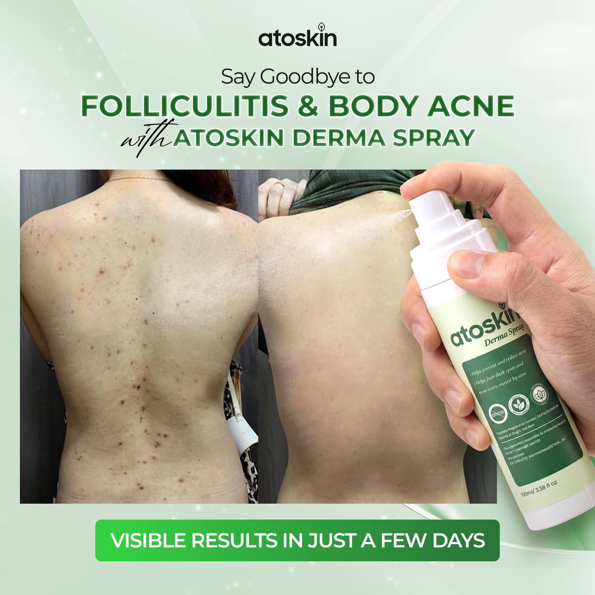 Atoskin Advanced Folliculitis & Back Acne Treatment Spray with 1.5% Glycolic Acid & 1% Zinc PCA - Reduces Redness & Keratosis Pilaris (3.4 oz)