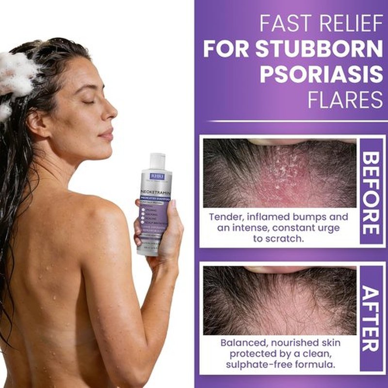Skiennix Anti-Fungal Shampoo - Medicated Formula for Dandruff & Folliculitis | Soothes Itchy Scalp | Paraben-Free