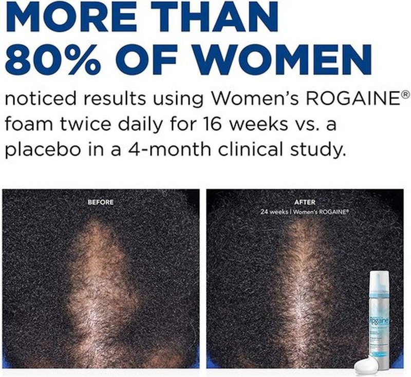 Rogaine 5% Minoxidil Foam - Once-A-Day Hair Loss Treatment for Women | Regrow Thicker Hair, Unscented, 2.11 oz