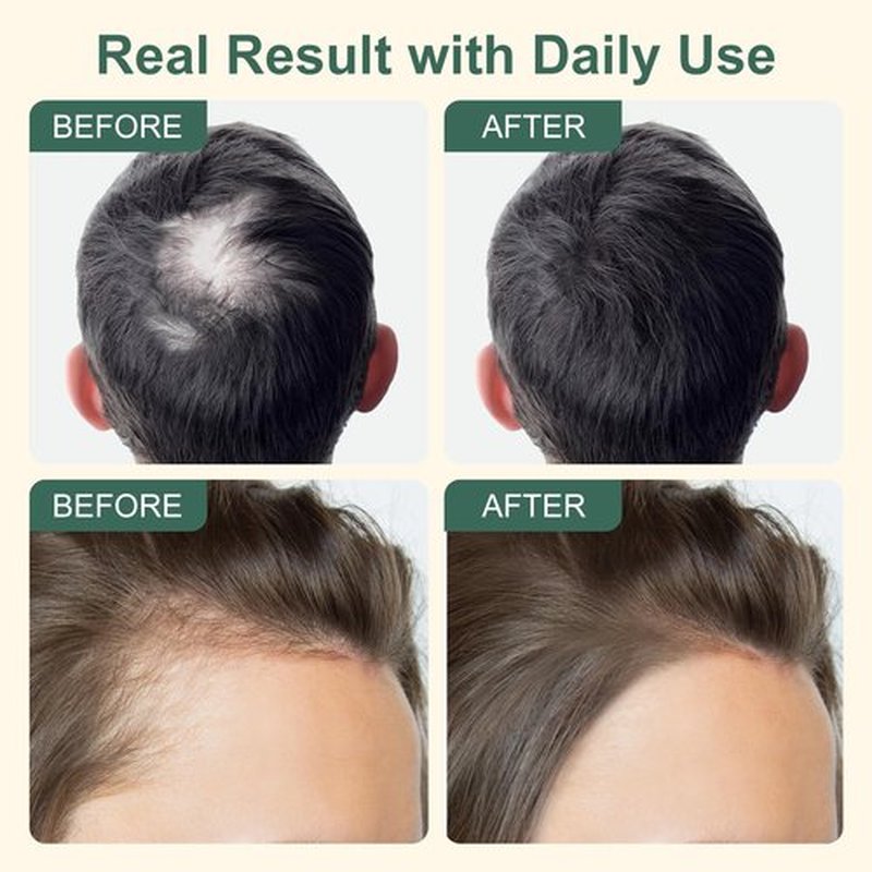 5% Minoxidil Hair Growth for Men and Women, Minoxidil Hair Loss Treatment Serum with Biotin & Herbal Extracts, Topical Hair Loss Treatment for Faster Stronger Thicker Hair Growth 2 Fl.oz