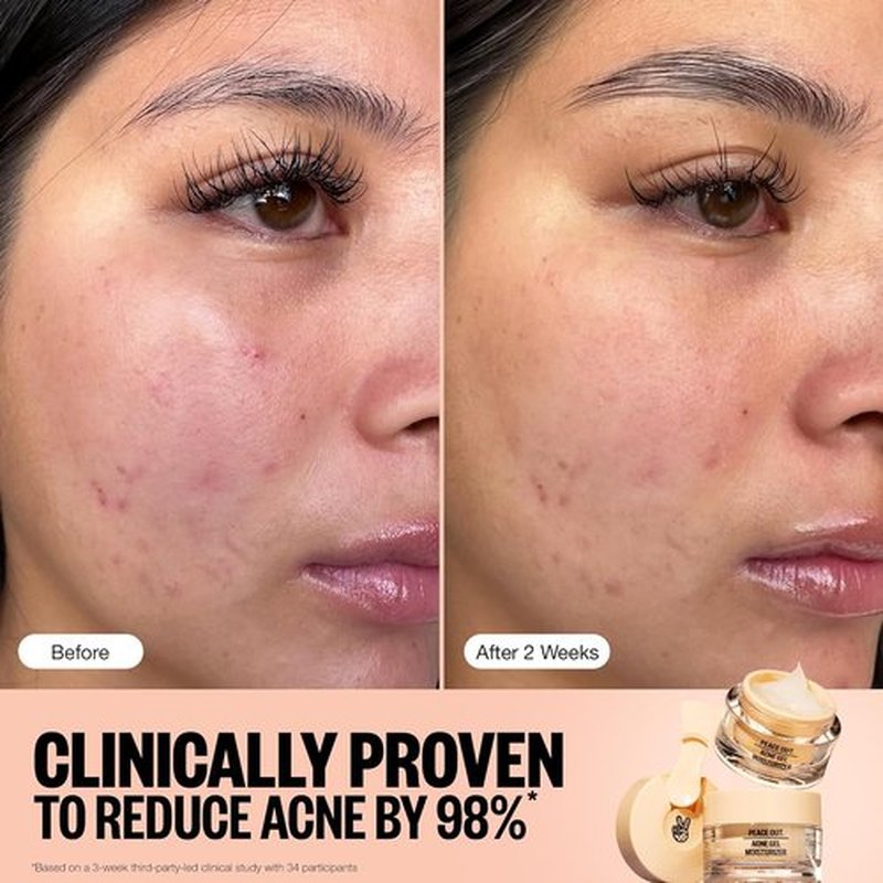 Peace Out Acne Gel Moisturizer - Face Cream for Oily, Acne-Prone Skin with 2% Salicylic Acid | 1.69 fl oz