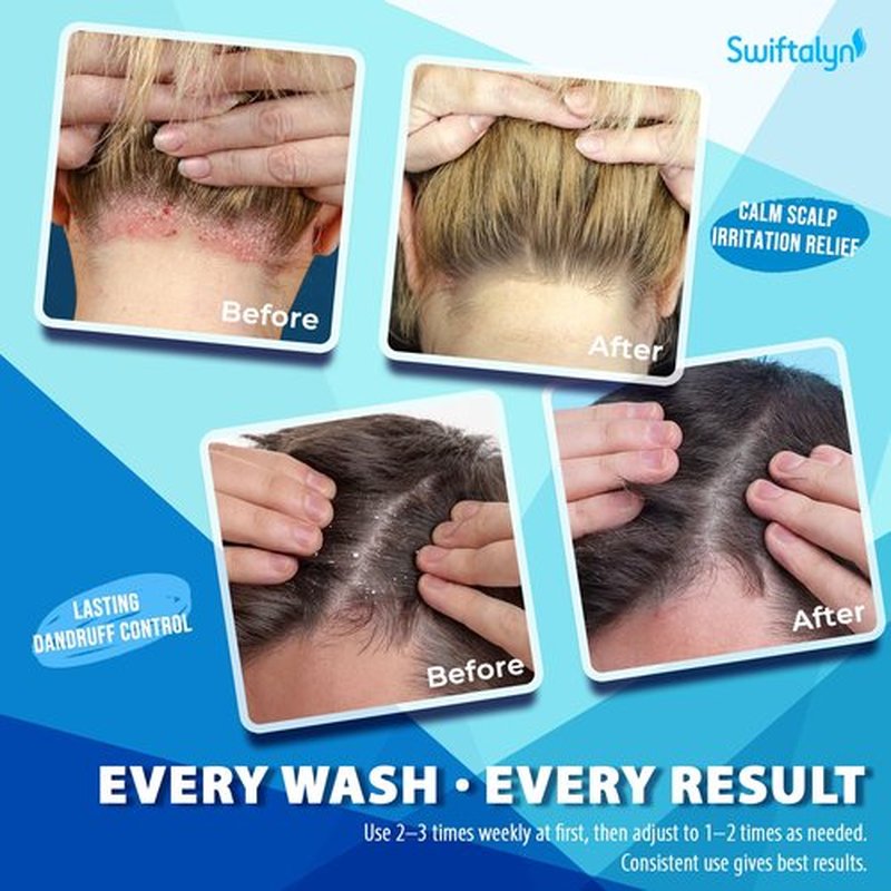 Swiftalyn Antifungal Shampoo for Seborrheic Dermatitis & Folliculitis: Psoriasis, Dandruff & Scalp Ance Shampoo for Men & Women – Soothes Itchy, Flaky Scalp – Sulfate-Free Formula