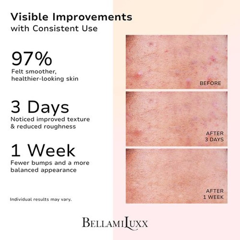 BellamiLuxx Butt Acne Treatment Set: Acne Soap Bar + Butt Treatment Lotion for Breakouts on Buttocks, Thighs, Back, Chest & Ingrown-Prone & Folliculitis-Prone Skin – Helps Reduce Body Breakouts