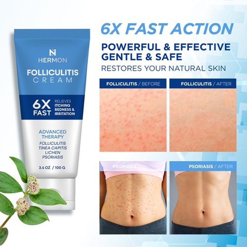 Hermon Folliculitis Cream: Effective for Folliculitis Scalp Face and Body 100g