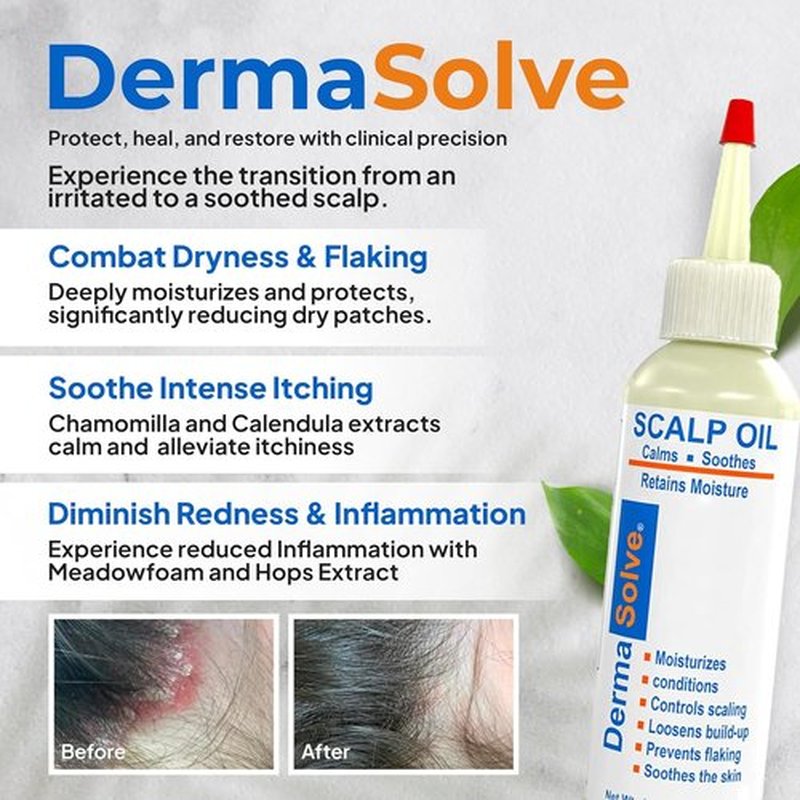 Dermasolve Scalp Oil - Flaky Scalp Relief for Psoriasis & Dandruff | 4 oz, Dermatologist Approved
