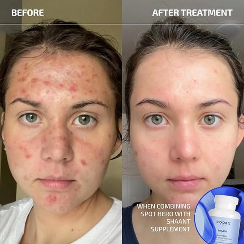 Codex Labs Shaant Spot Hero - 5% Sulfur Acne Treatment for Sensitive Skin | Shrinks Breakouts | 0.5 oz