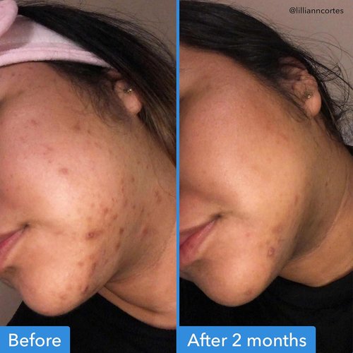 Good Molecules Discoloration Correcting Serum - Target Dark Spots & Hyperpigmentation - 1 FL Oz Face Care