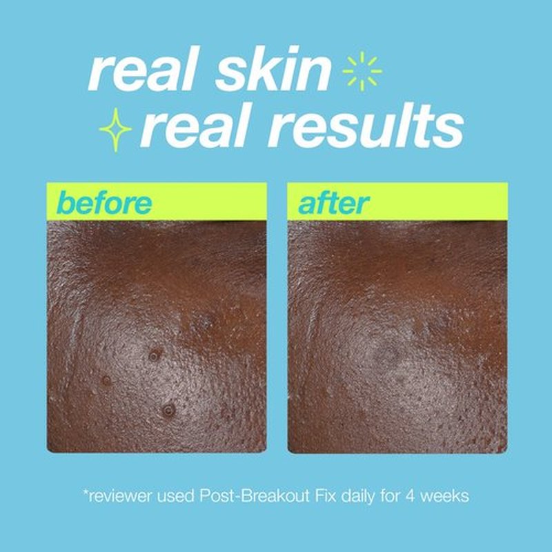 Dermalogica Clear Start Post-Breakout Fix, Acne Dark Spot Treatment with Salicylic Acid, Squalene & Hexylresorcinol, Fade + Brighten Acne Marks