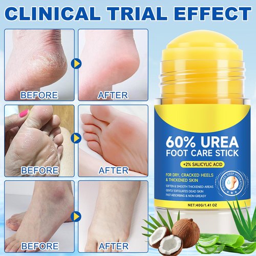 Alstaky 60% Urea Foot Care Stick plus 2% Salicylic Acid, Foot Lotion Hydrates & Nourish, Provides Deep Hydration, Soften & Smooth Thickened Areas, Fast-Absorbing, for Women and Men