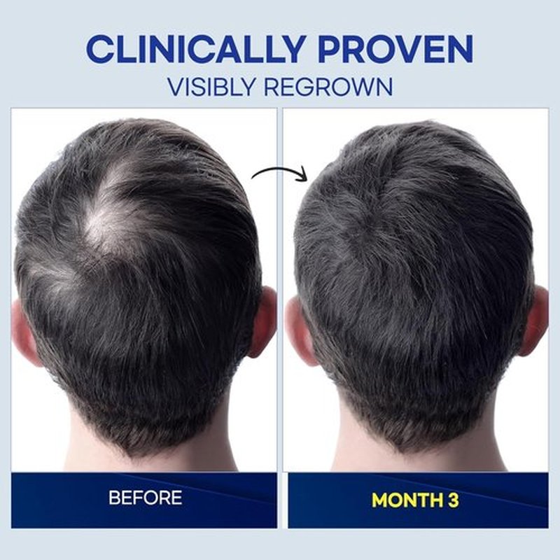 ProBliva 5% Minoxidil for Men Spray: Extra Strength 5% Minoxidil Topical Hair Growth Treatment - Clinically Proven Solution for Hair Loss & Thinning - Made in USA (2 Fl Oz (Pack of 1))