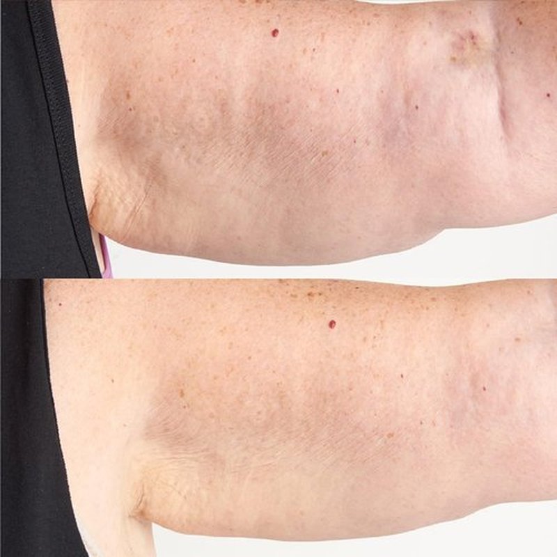 Skiennix High Potency Hyaluronic Body Therapy - Intensive Moisturizer, 6 Fl. Oz.