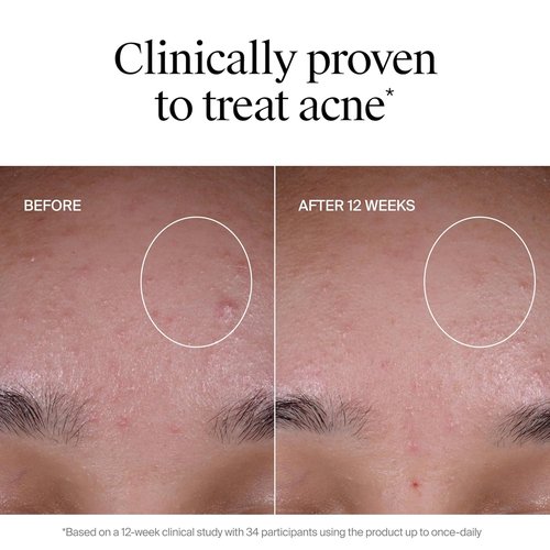 Neutrogena Evenly Clear Acne Exfoliant - Multi-Acid Treatment Serum for Smooth, Even Skin Tone | 1 fl. oz