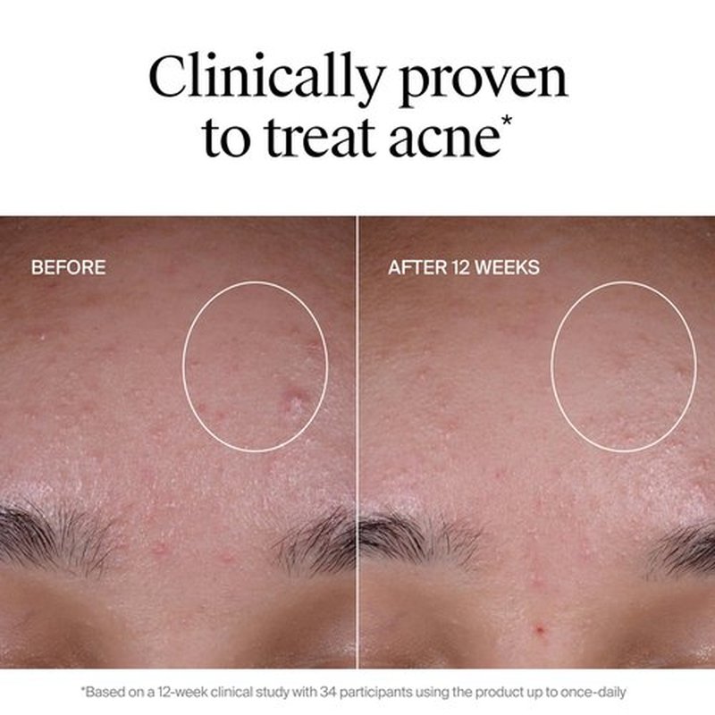 Neutrogena Evenly Clear Acne Exfoliant with Salicylic Acid & Mandelic Acid, Multi-Acid Face Exfoliating Treatment Serum Visibly Fade the look of Post-Acne Marks for A Smooth, Even Skin Tone, 1 fl. oz