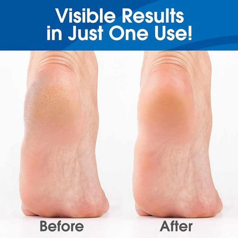 DeEnti Callus Remover Gel - Extra Strength 8oz for Dry Skin & Cracked Heels | Salon-Grade Foot Care