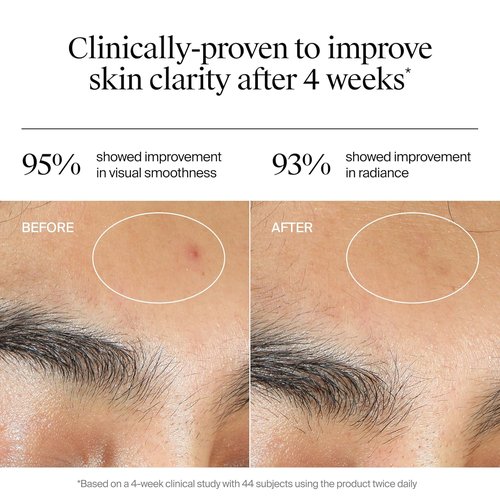 Neutrogena Evenly Clear Acne Gel Moisturizer - Lightweight Formula with Salicylic Acid & N-Acetyl Glucosamine | 1.7 fl. oz