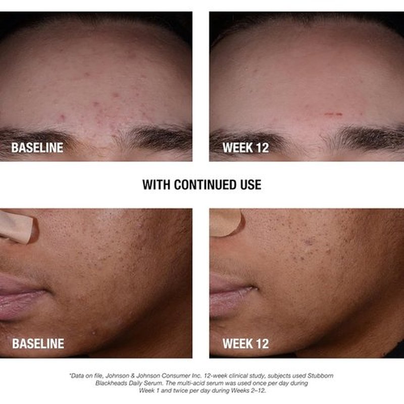 Neutrogena Acne Facial Serum - Daily Treatment for Stubborn Blackheads | Oil-Free, 1 fl. oz
