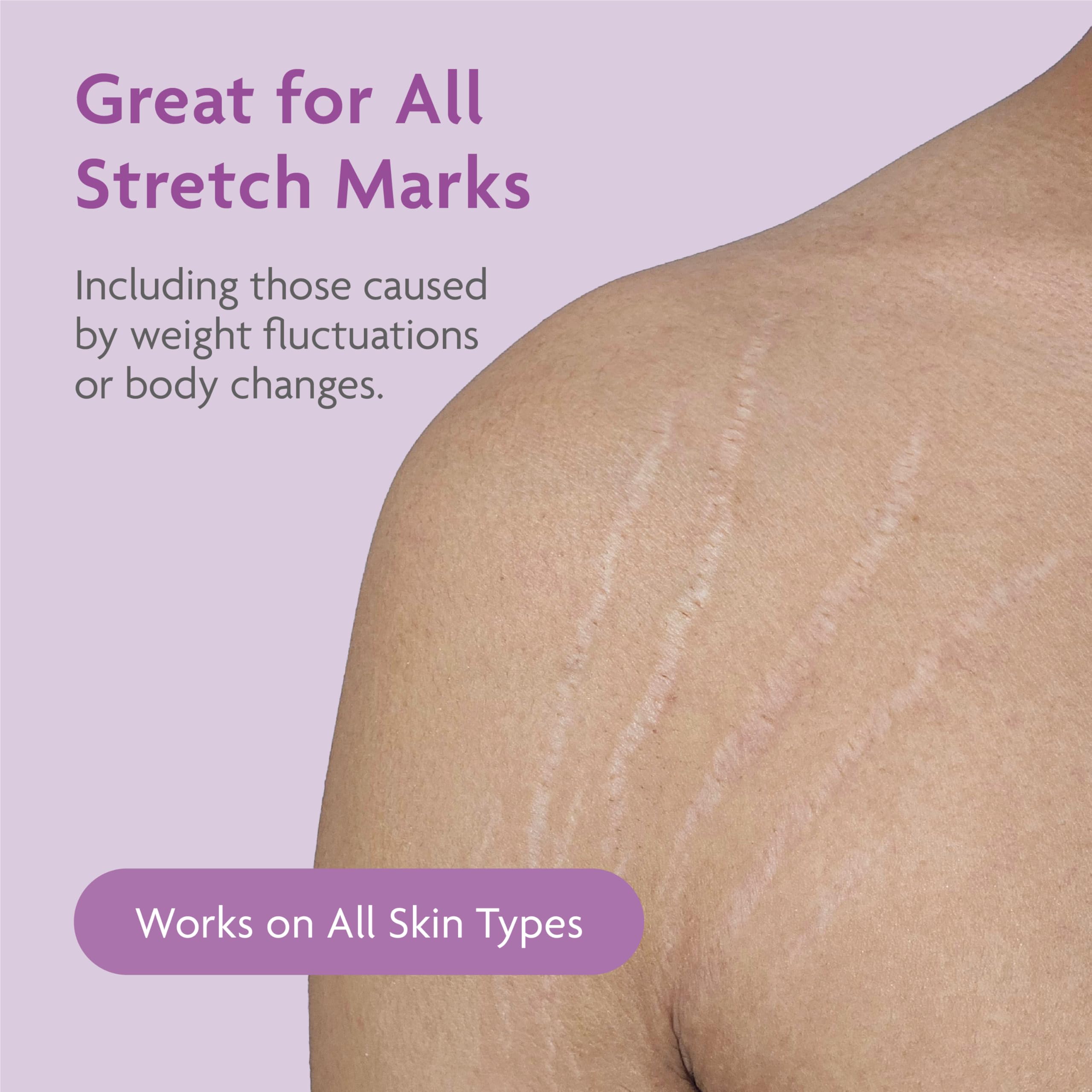 TriLASTIN Stretch Mark Cream & Serum Bundle - Intensive Stretch Mark Cream Treatment - Hyaluronic Acid Hydrothermal Accelerator - Maternity Skin Care Essential - 5.5 Oz Jar, 3 Oz Accelerator