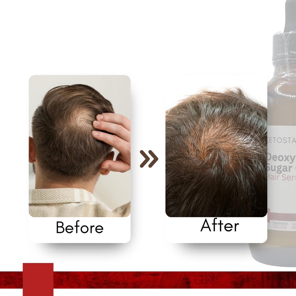 Ketostat Deoxyribose Sugar Gel 2-Deoxy-d-ribose 2dDR Hair Growth 110ml / 3.75 oz - Backbone of DNA - Stimulate the Formation of new Blood Vessels for Men or Women