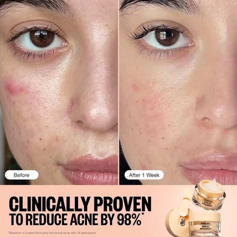 Peace Out Acne Gel Moisturizer - Face Cream for Oily, Acne-Prone Skin with 2% Salicylic Acid | 1.69 fl oz