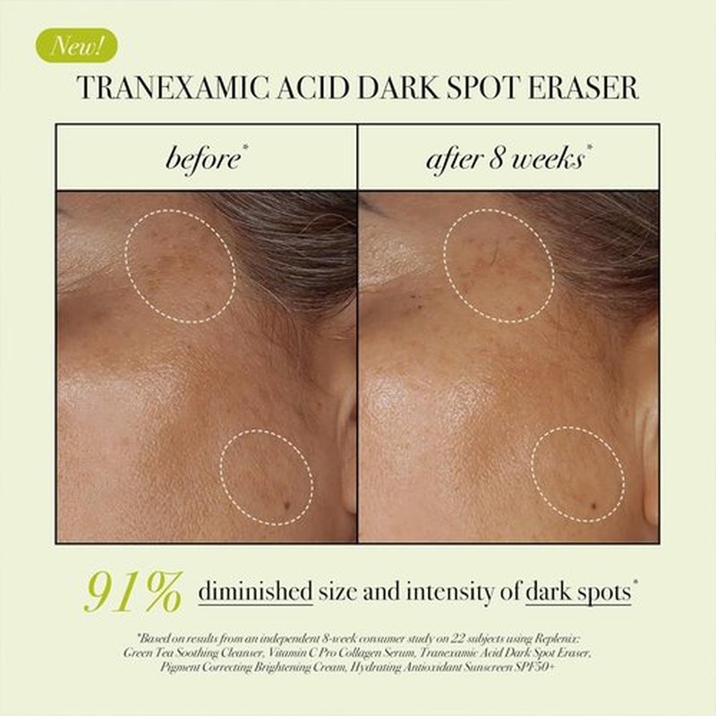 Replenix Tranexamic Acid Dark Spot Treatment - Medical-Grade Serum for Uneven Skin Tone | 0.5 oz, Gluten-Free