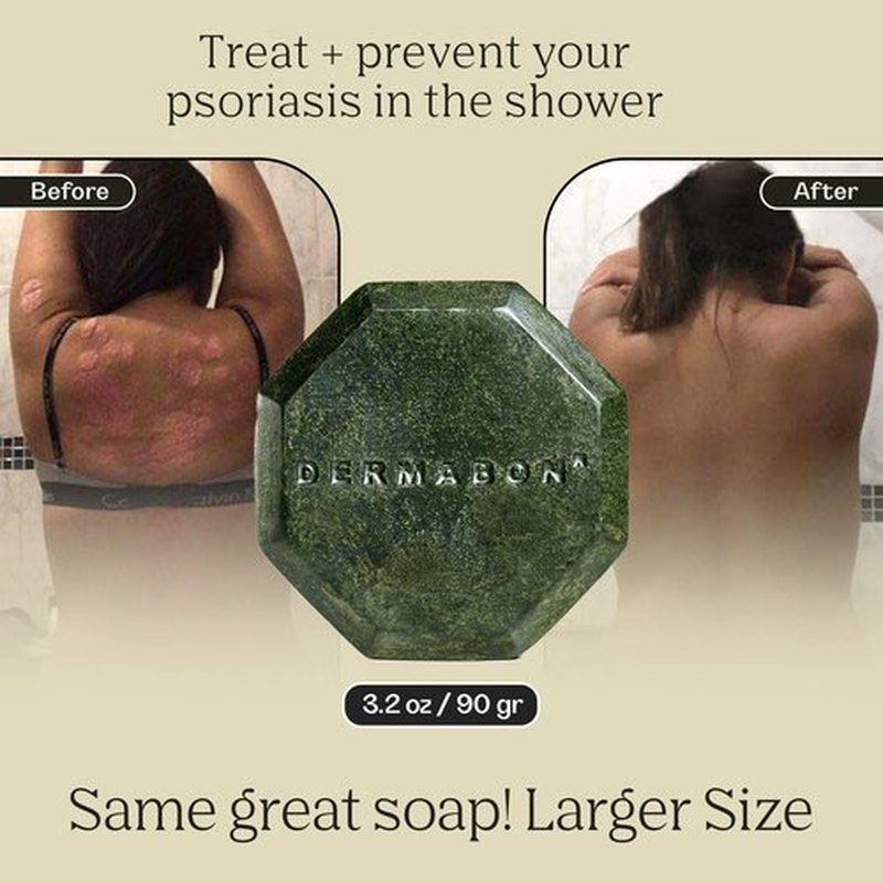 Dermabon Psoriasis, Dermatitis & Dandruff Control soap bar with 2% Coal Tar as its Active Ingredient - 1 Pack