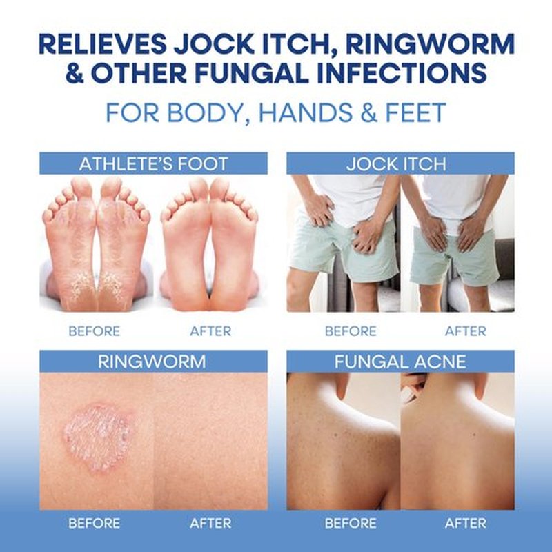 Hermon Antifungal Soap with Tea Tree Oil: Antifungal Bar Soothing Care & Relief of Itchy for Ringworm Jock Itch Athletes Foot - Body & Face Wash (1-Pack (2 Bars Original Tea Tree))