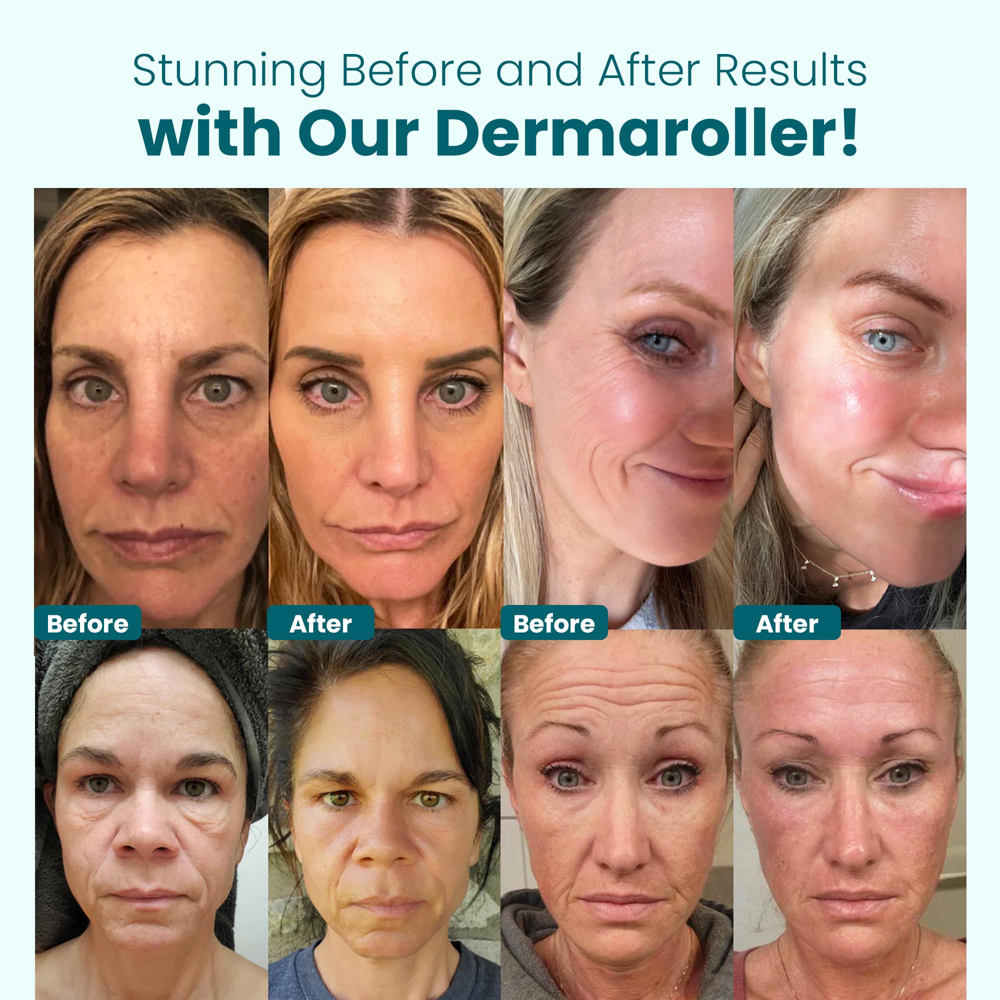 Derma Roller 0.25 mm with Individual Needles | Facial, Scalp & Head Micro-Needling Tool for Enhanced Skincare Routine - Gin Amber Beauty