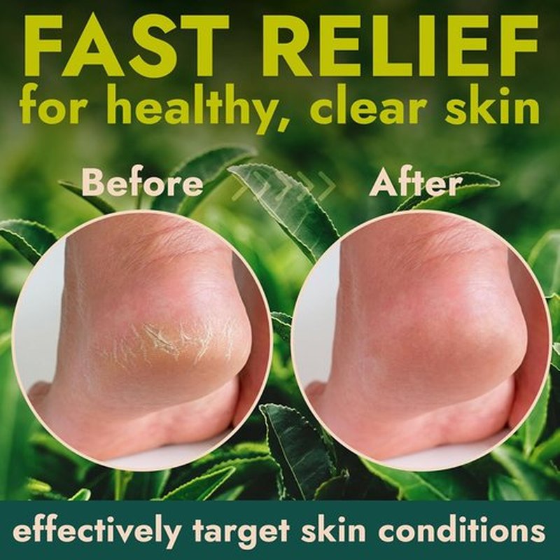 Skiennix Callus Remover Gel - Extra Strength Treatment with Tea Tree Oil | 14 fl oz | 50 Applications + 3 Pumice Stones