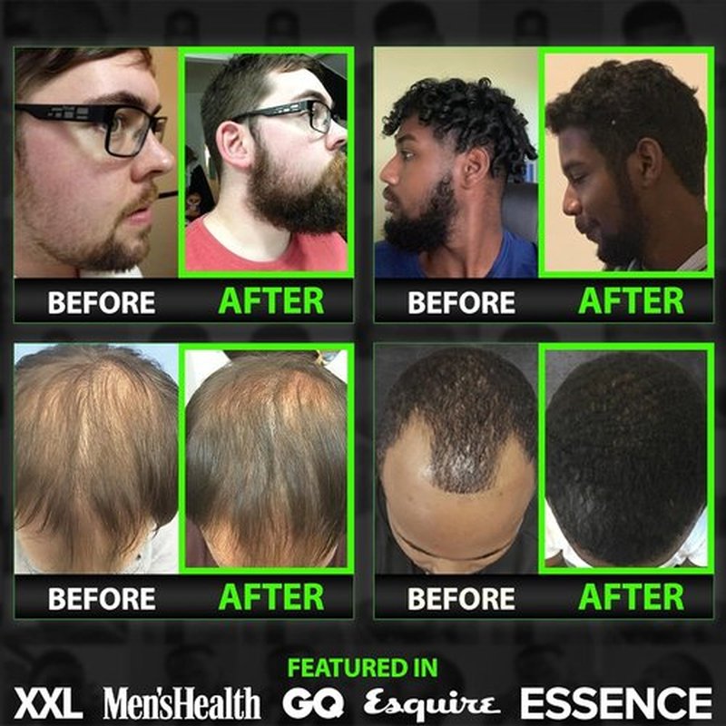 Skiennix Beard Growth Serum - Maximum XXL Oil for Men - Thickens & Fills Patches - Facial Hair & Scalp Treatment