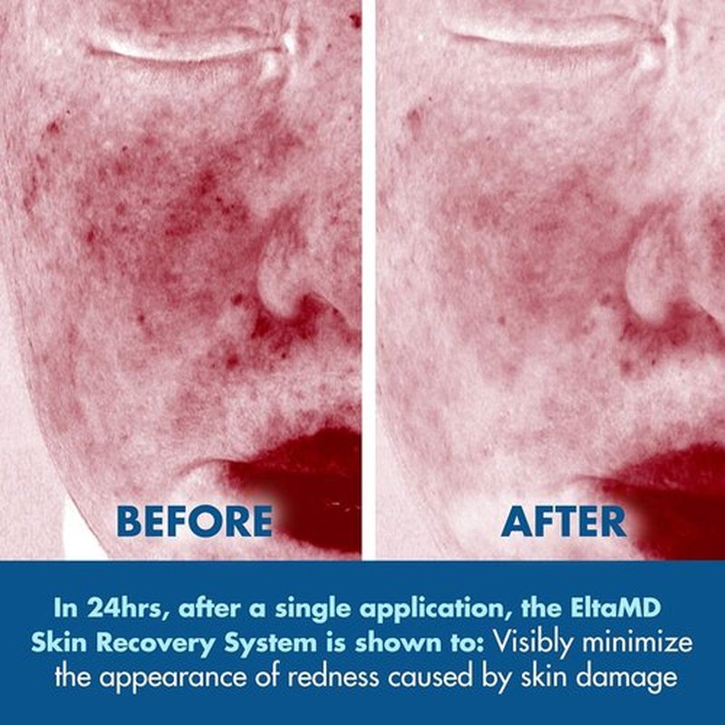 EltaMD Skin Recovery System - 3-Piece Facial Care Set with Gentle Toner, Serum & Moisturizer