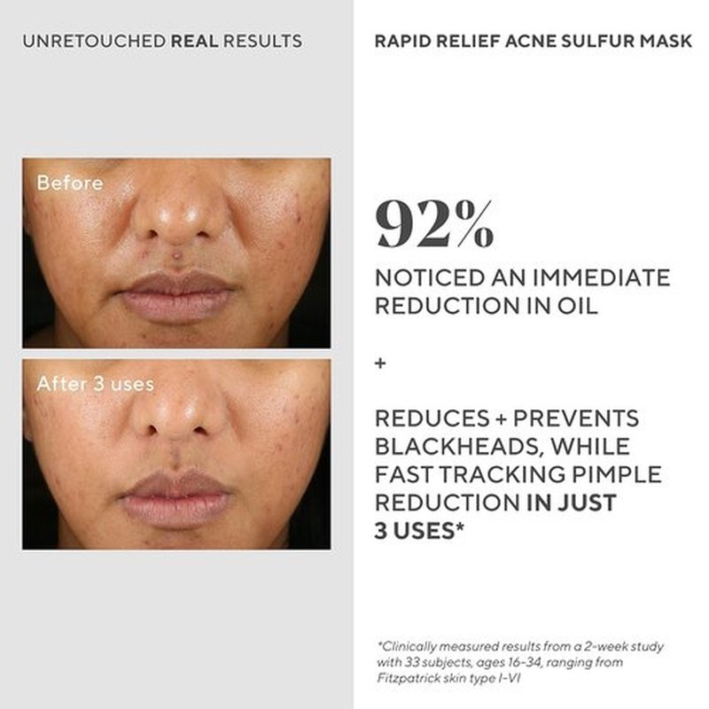 Murad Rapid Relief Acne Sulfur Mask - Clay Mask with Salicylic Acid & 5% Sulfur | Reduces Breakouts & Unclogs Pores - 2.5 Fl Oz
