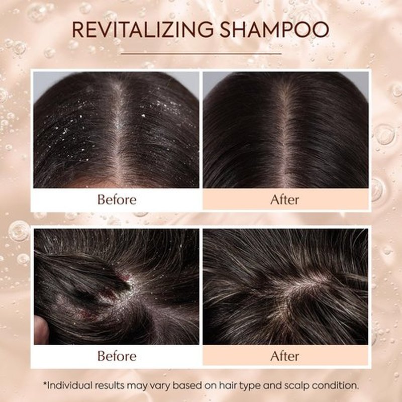 Antifungal Shampoo for Women Folliculitis Treatment: Seborrheic Dermatitis Shampoo for Flaky & Itchy Scalp Relief - Psoriasis Shampoo with 2% Salicylic Acid & Sophora Flavescens Root - 8.45 fl. oz
