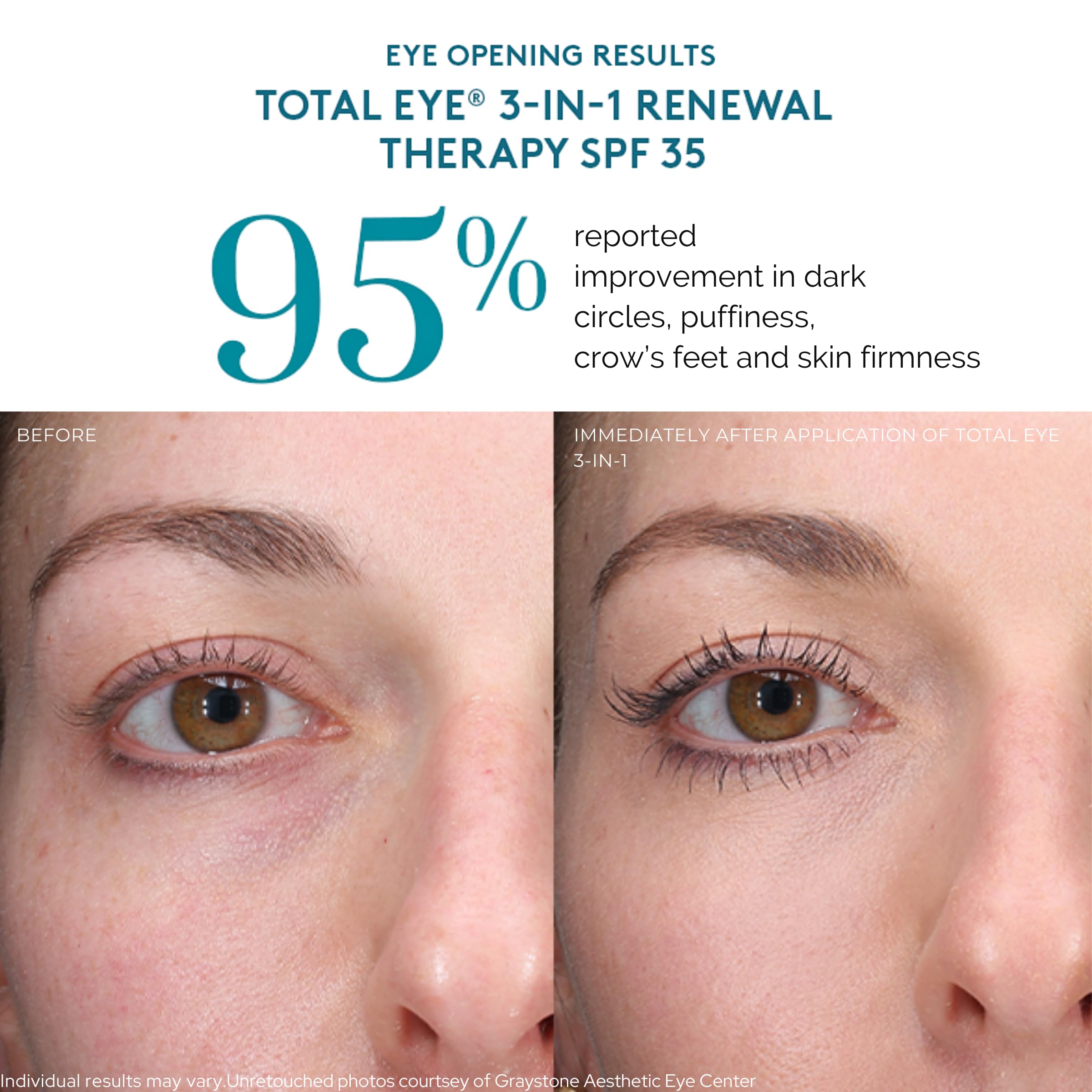 Colorescience Total Eye 3-in-1 Anti-Aging Renewal Therapy for Wrinkles & Dark Circles, SPF 35, Tan